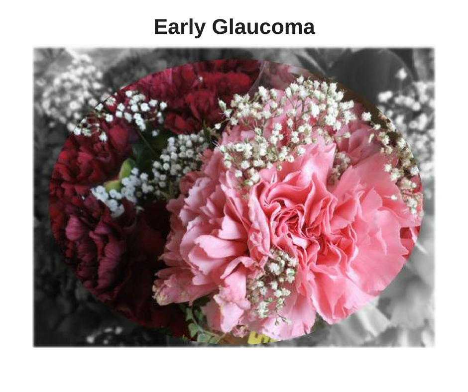 , Glaucoma, The Eye Place