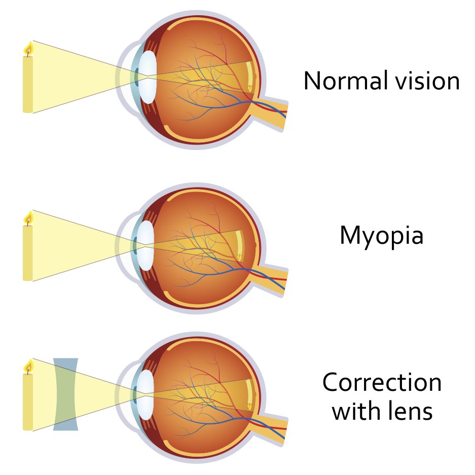 Vision conditions, Vision Problems, The Eye Place